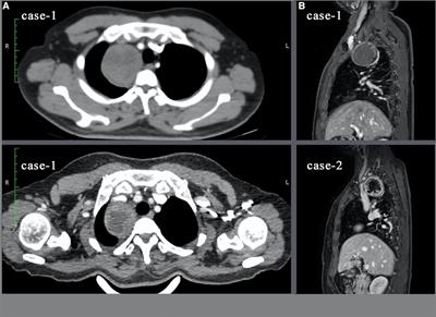 Single-port robotic surgery for mediastinal tumors using the da vinci SP system: Initial experience